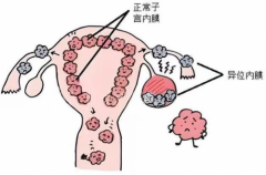 子宫内膜异位症：了解这一常见妇科疾病